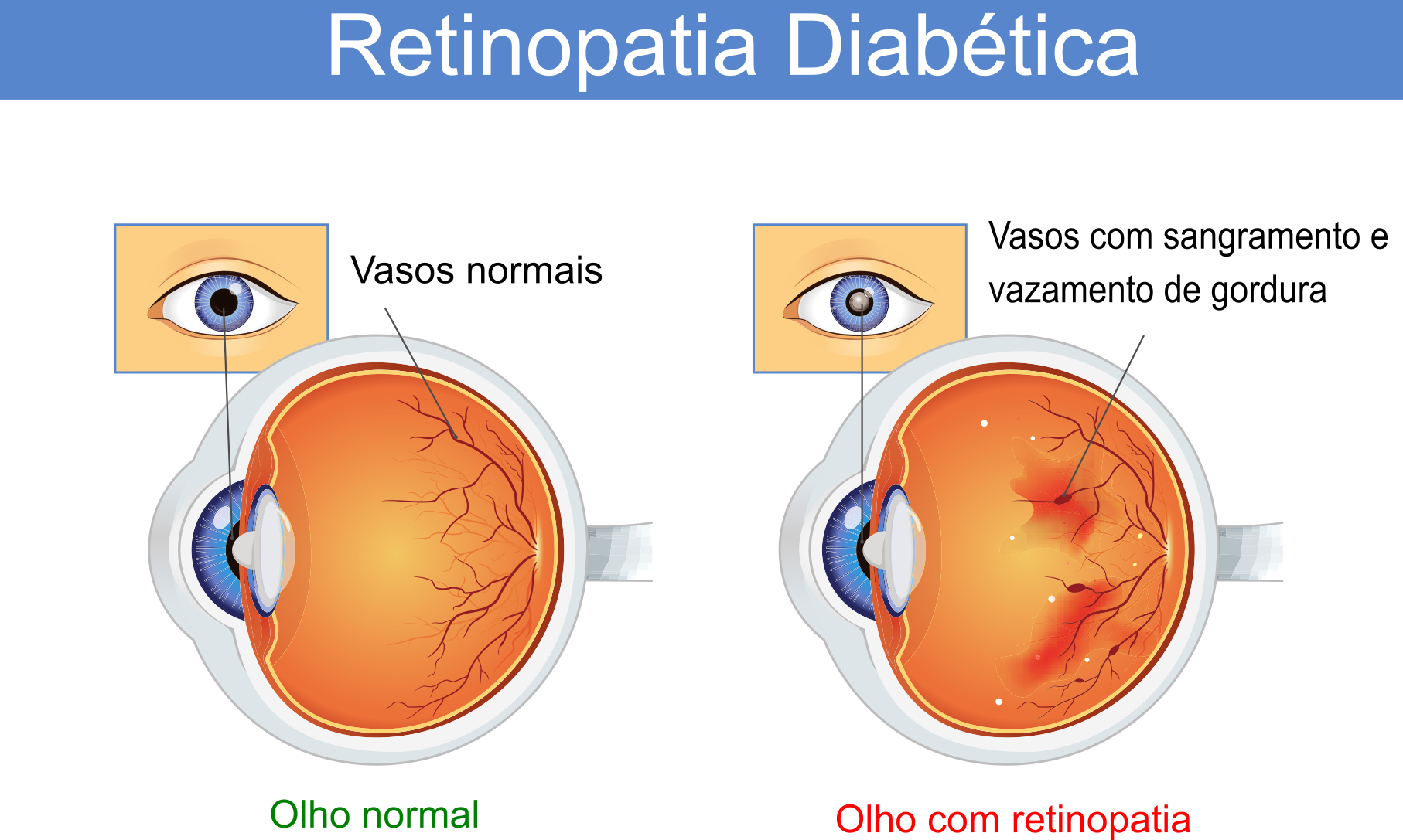 Tratamento da Retina - Instituto de Moléstias Oculares